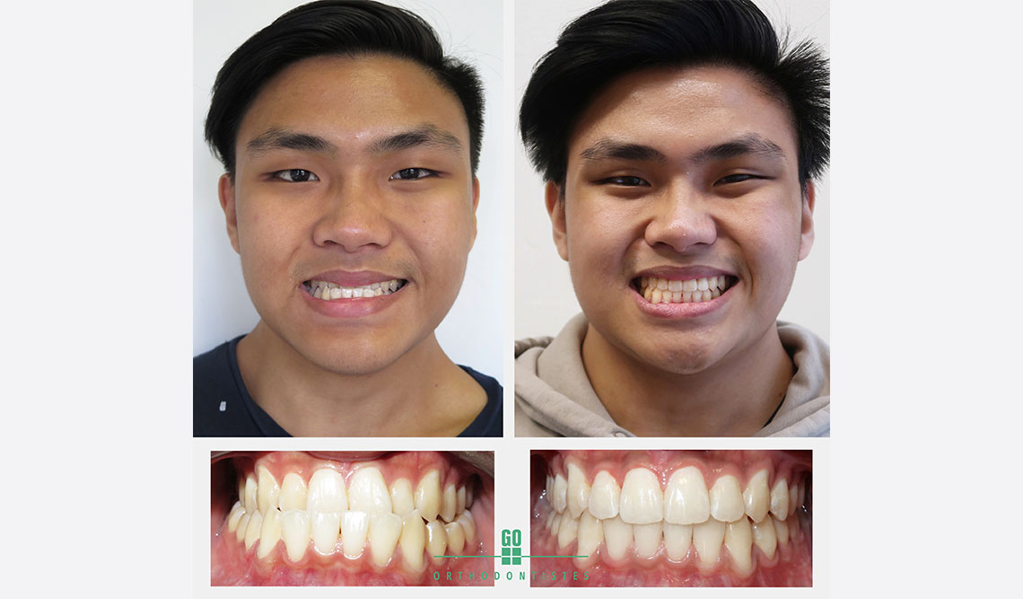 https://goorthodontistes.com/wp-content/uploads/2018/11/the-benefits-of-having-straight-teeth.jpg
